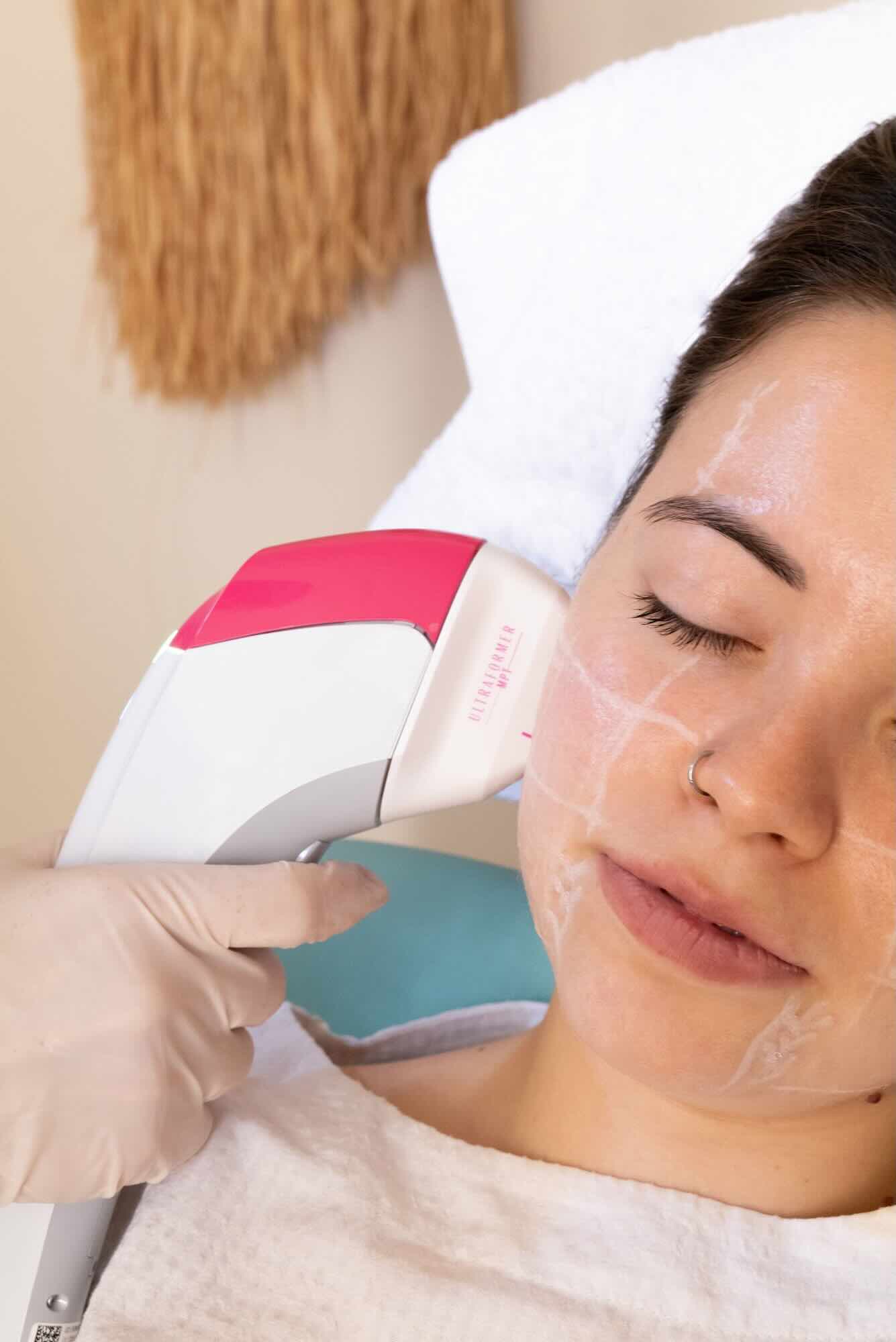 HIFU facial es un tratamiento efectivo para redefinir el óvalo facial.